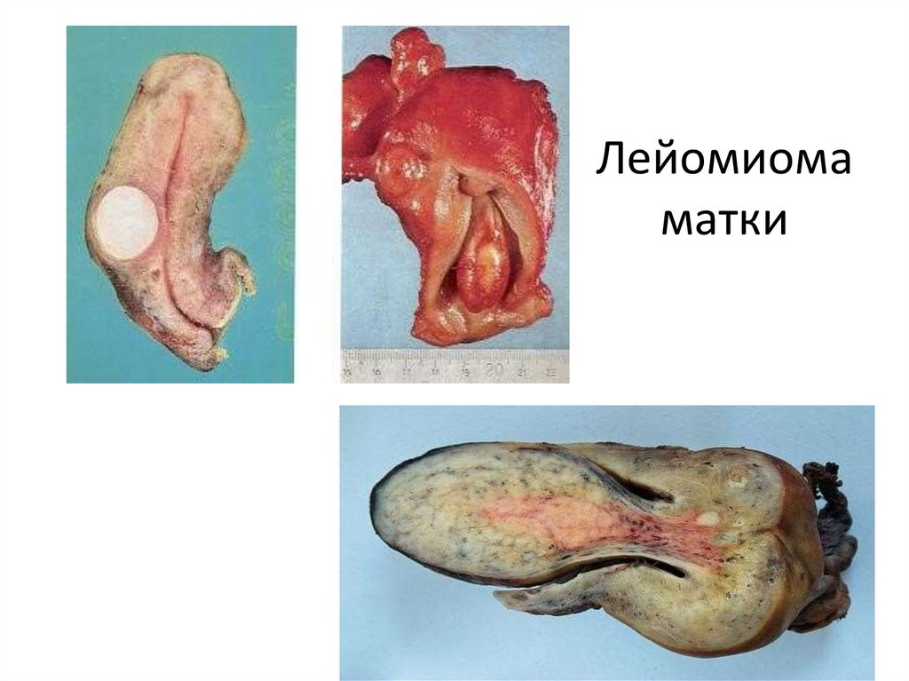 Лейомиома матки