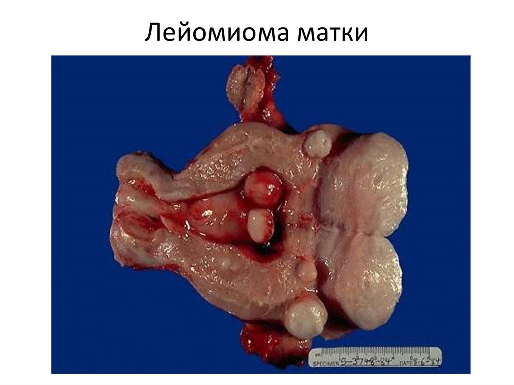 Лейомиома матки