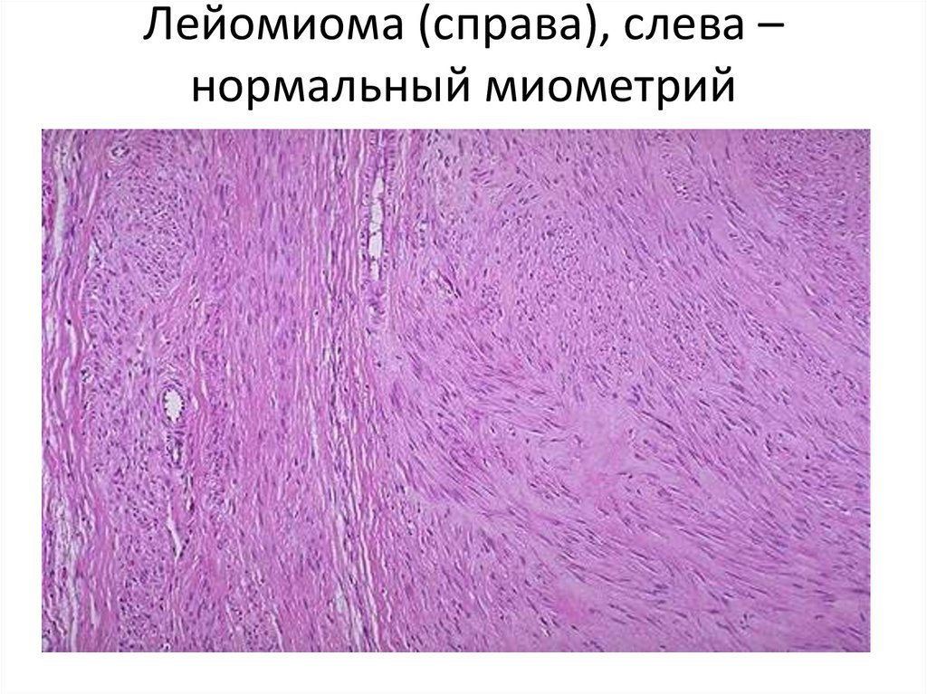Лейомиома (справа), слева – нормальный миометрий