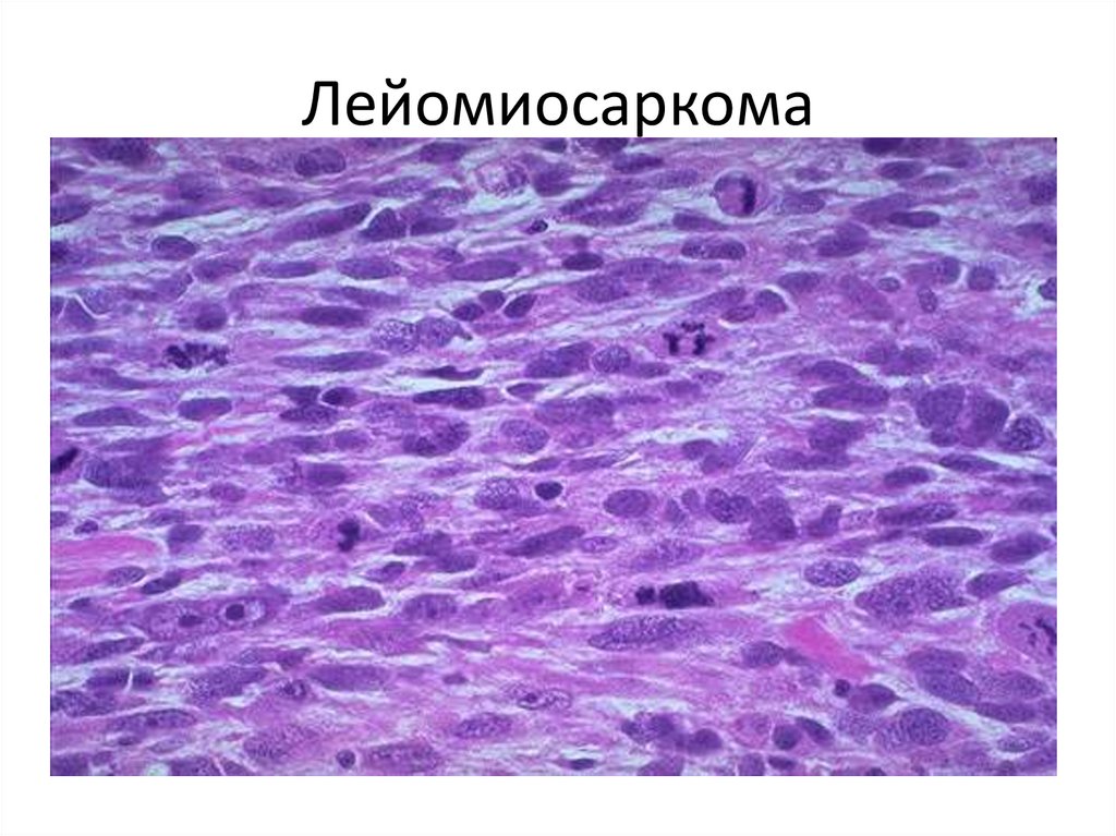 Лейомиосаркома