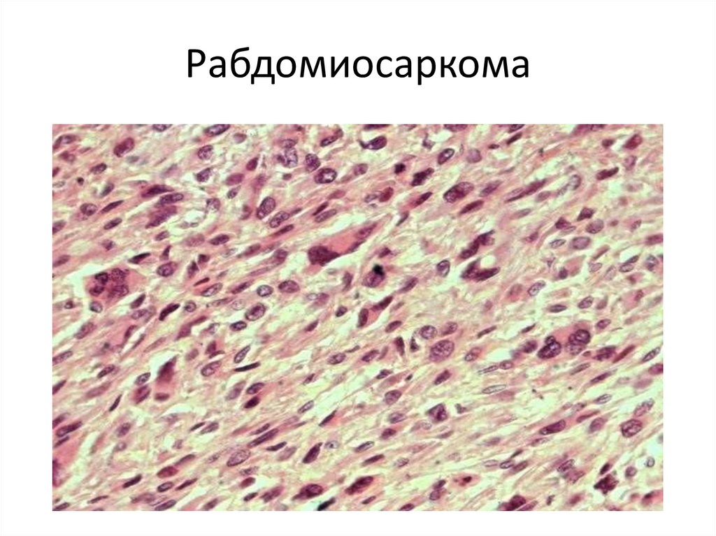 Рабдомиосаркома