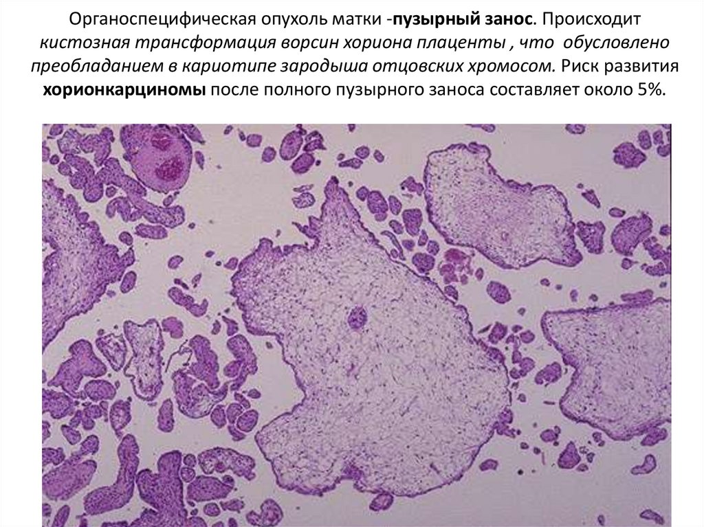 Органоспецифическая опухоль матки -пузырный занос. Происходит кистозная трансформация ворсин хориона плаценты , что обусловлено