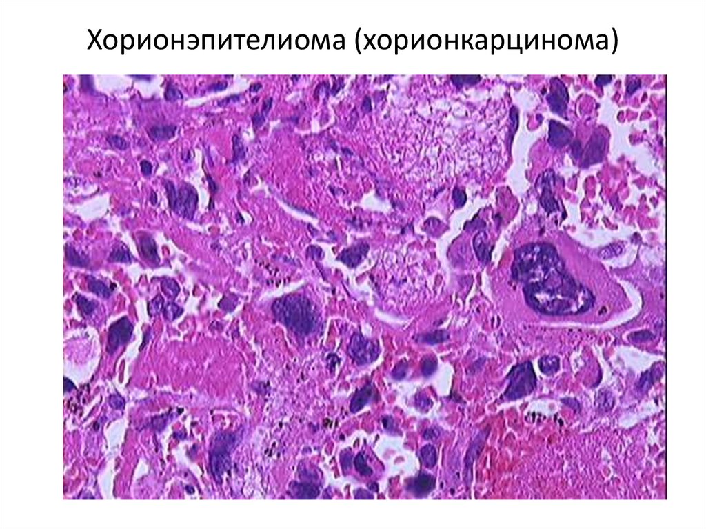 Хорионэпителиома (хорионкарцинома)