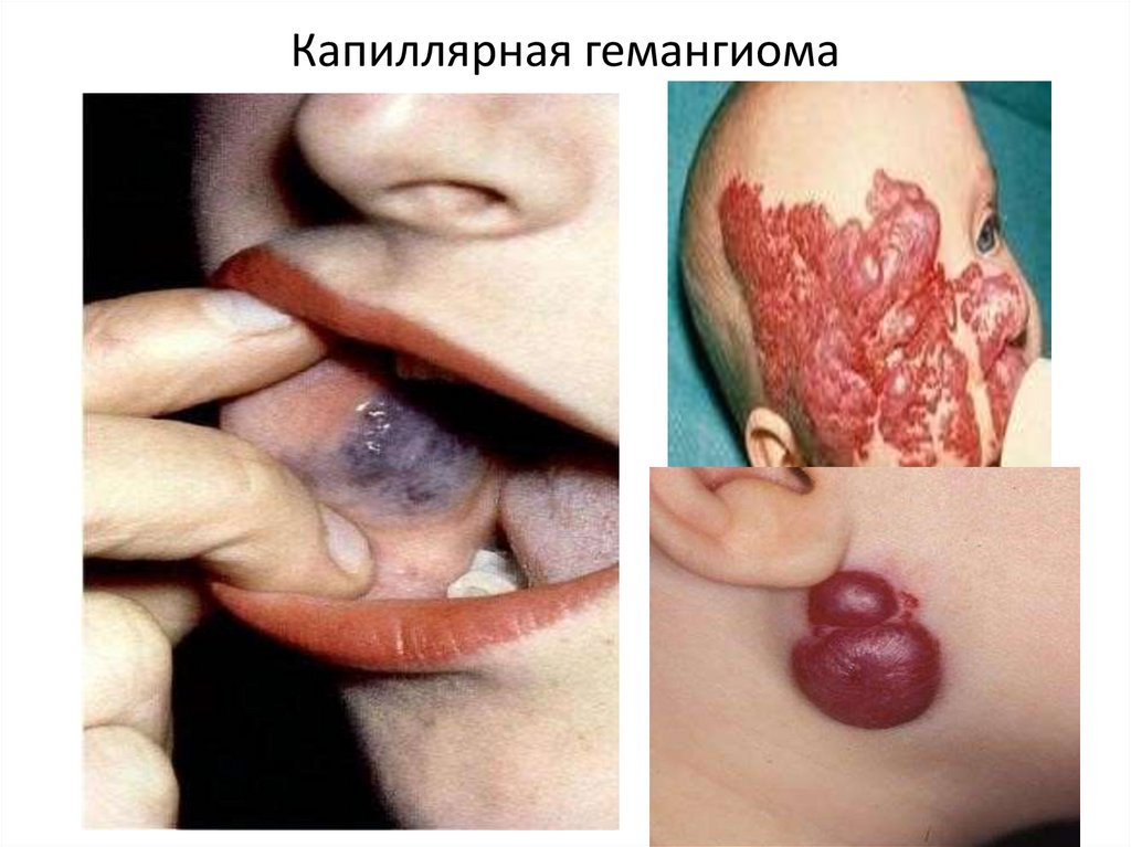 Капиллярная гемангиома