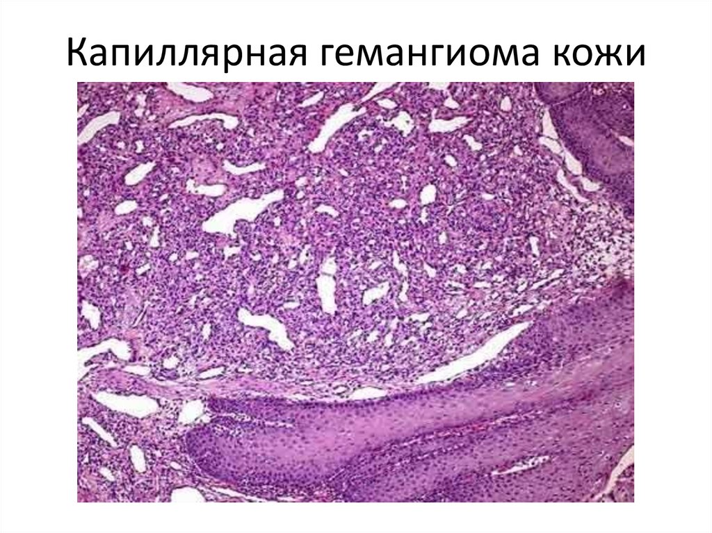 Капиллярная гемангиома кожи