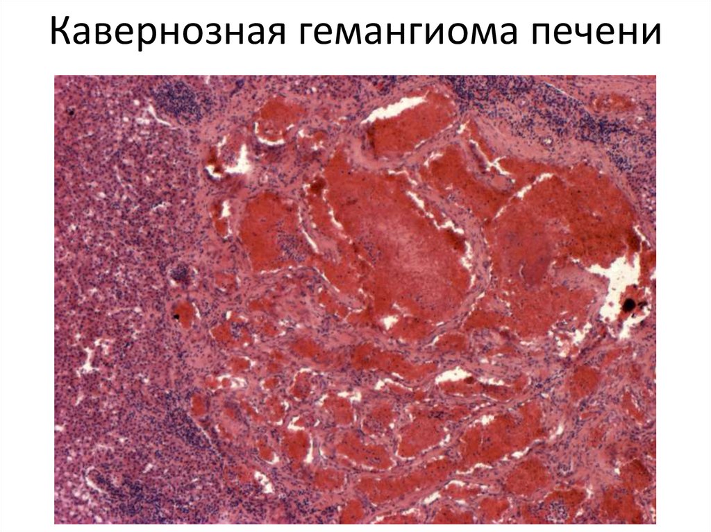 Кавернозная гемангиома печени