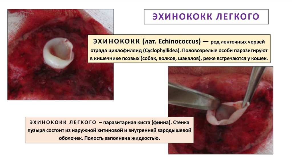 ЭХИНОКОКК ЛЕГКОГО