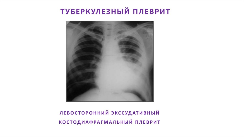 ЛЕВОСТОРОННИЙ ЭКССУДАТИВНЫЙ КОСТОДИАФРАГМАЛЬНЫЙ ПЛЕВРИТ