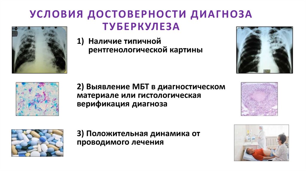 УСЛОВИЯ ДОСТОВЕРНОСТИ ДИАГНОЗА ТУБЕРКУЛЕЗА