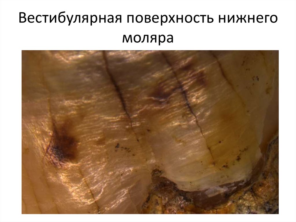 Вестибулярная поверхность нижнего моляра