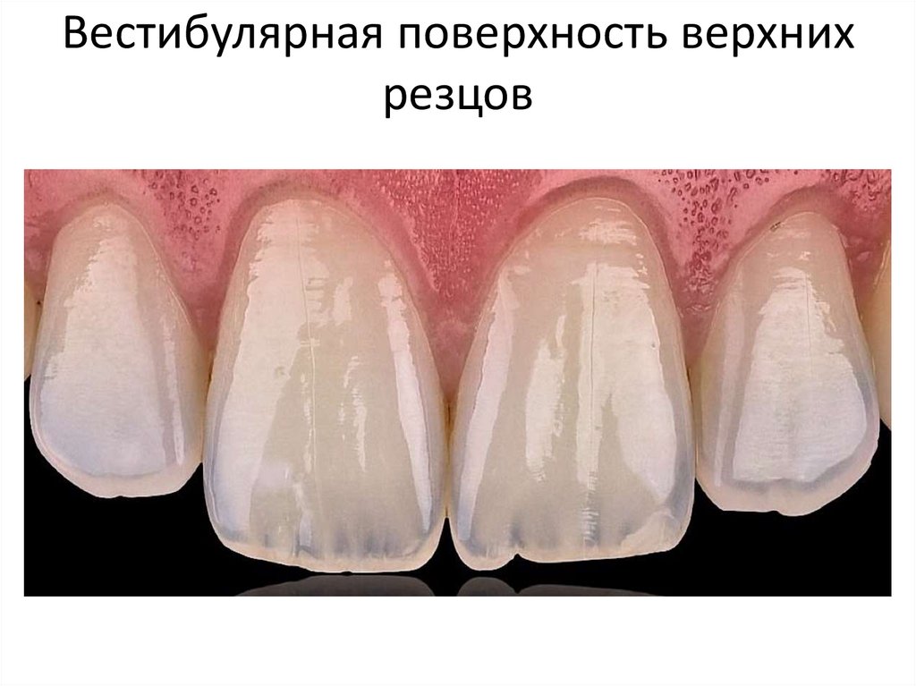 Вестибулярная поверхность верхних резцов