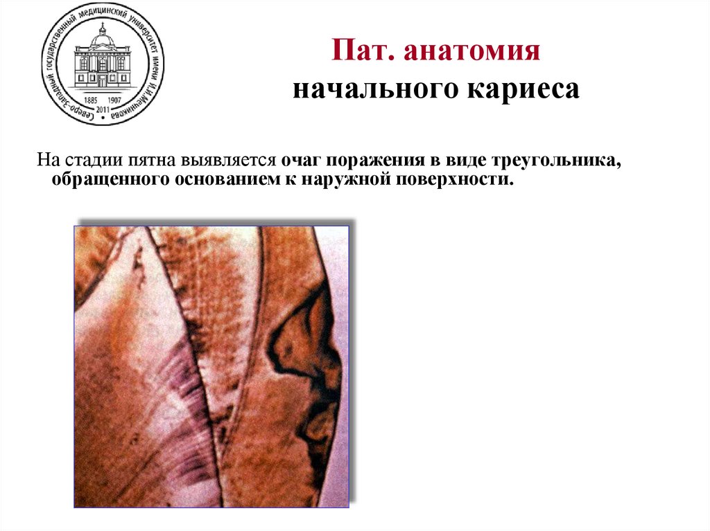 Пат. анатомия начального кариеса