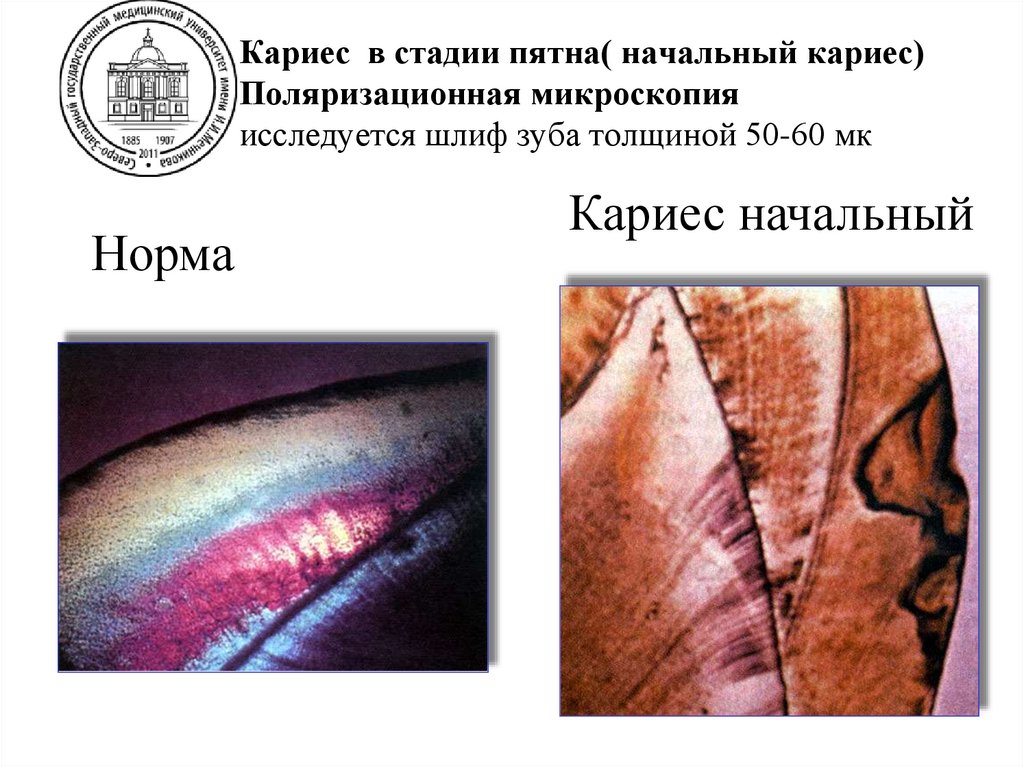 Кариес в стадии пятна( начальный кариес) Поляризационная микроскопия исследуется шлиф зуба толщиной 50-60 мк