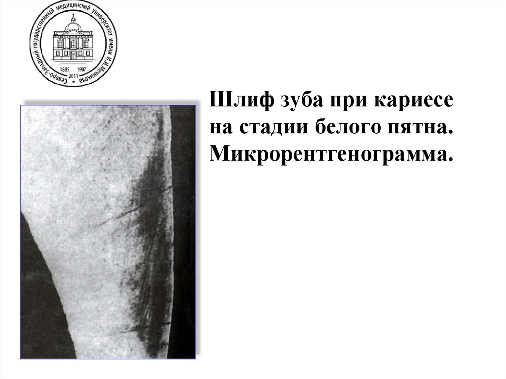 Шлиф зуба при кариесе на стадии белого пятна. Микрорентгенограмма.
