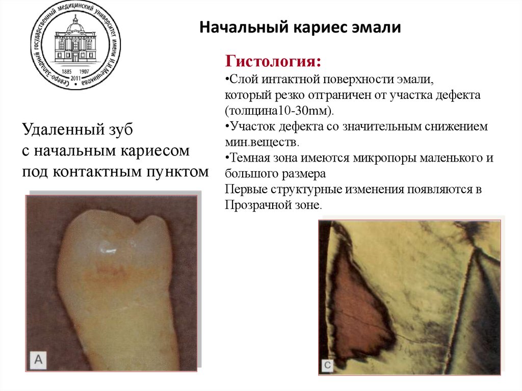 Начальный кариес эмали