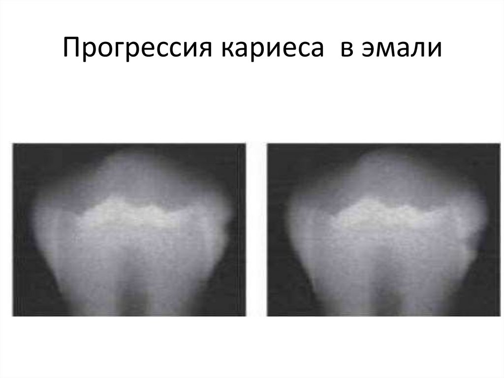 Прогрессия кариеса в эмали