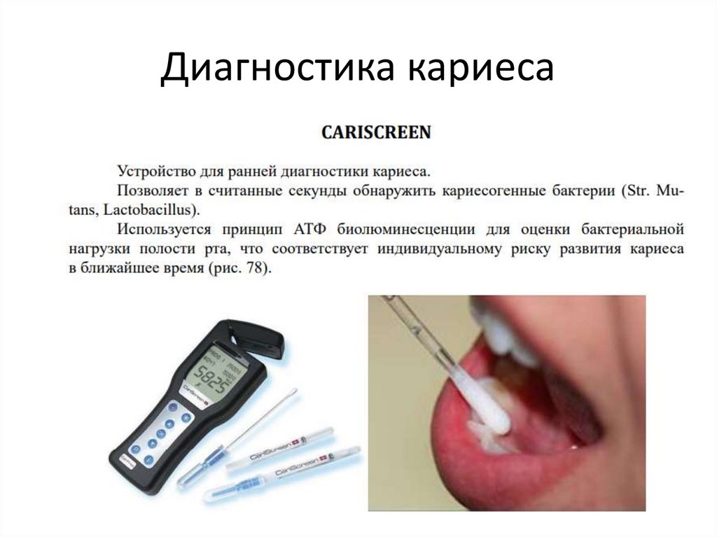 Диагностика кариеса