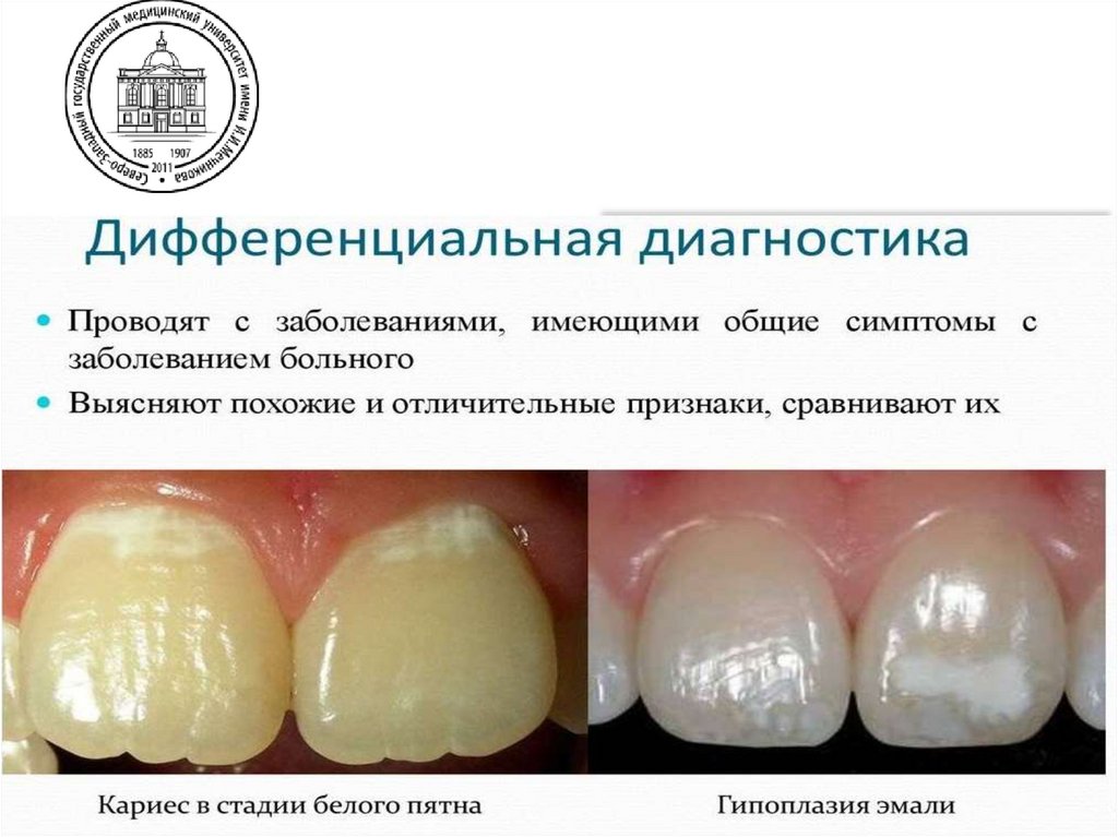 Диф. диагностика начального кариеса