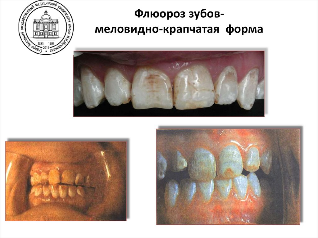 Клинические формы флюороза