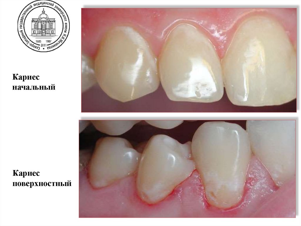 Диф. диагностика начального кариеса с поверхностным кариесом