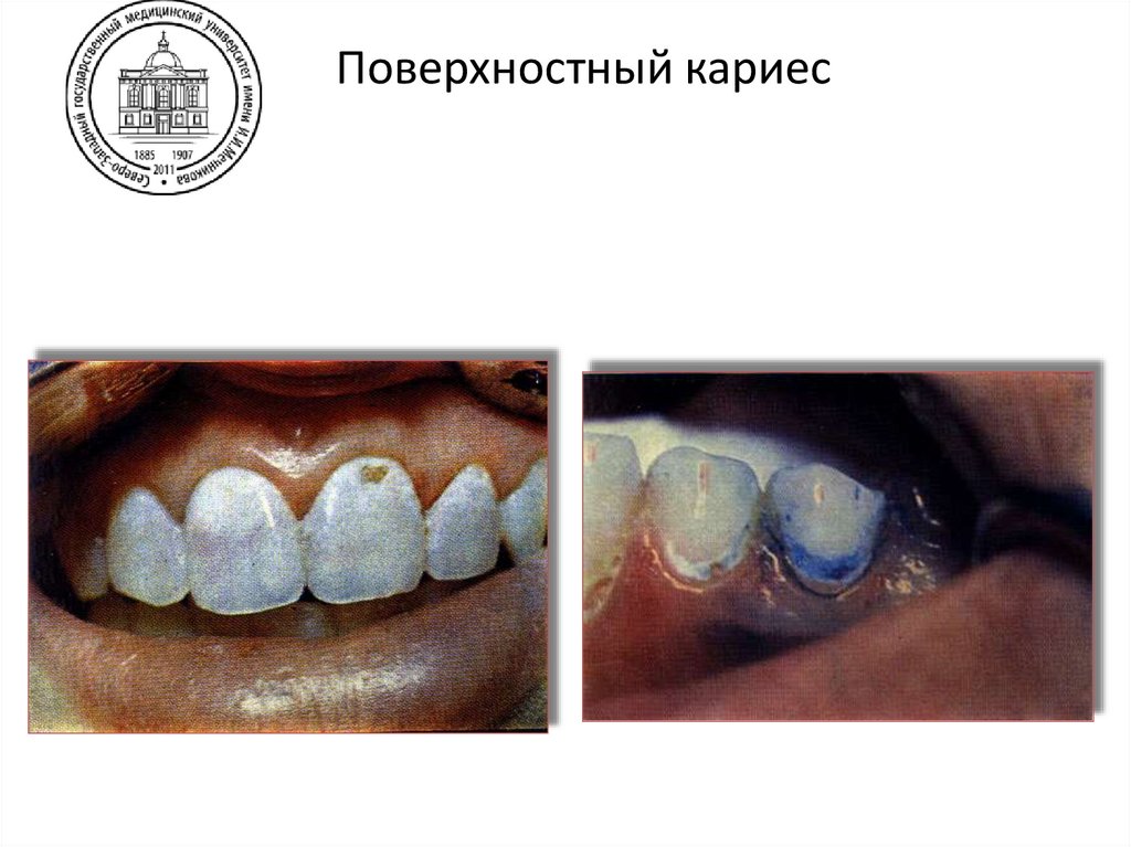 Начальный кариес гладких поверхностей