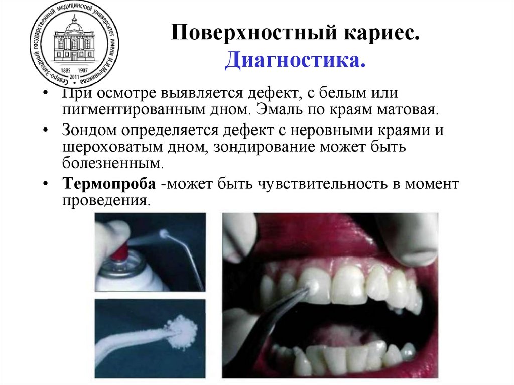 Поверхностный кариес. Жалобы, в зависимости от локализации кариозного процесса.