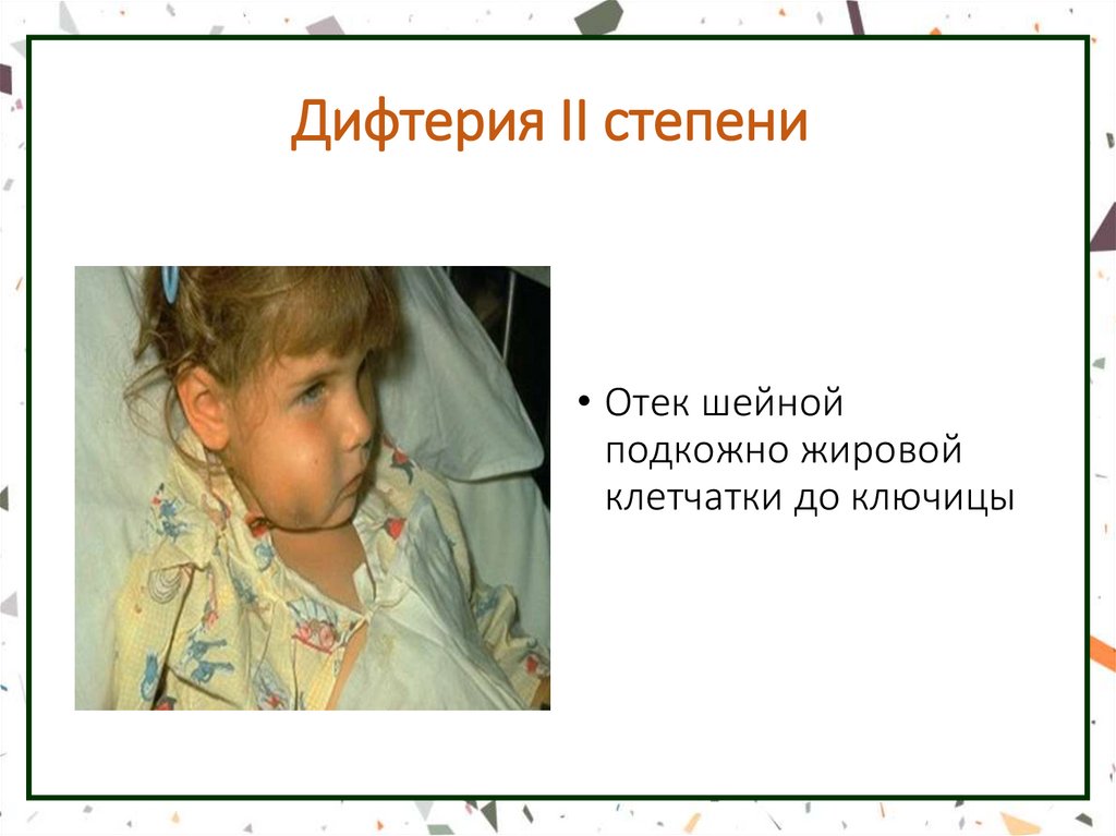 Дифтерия II степени