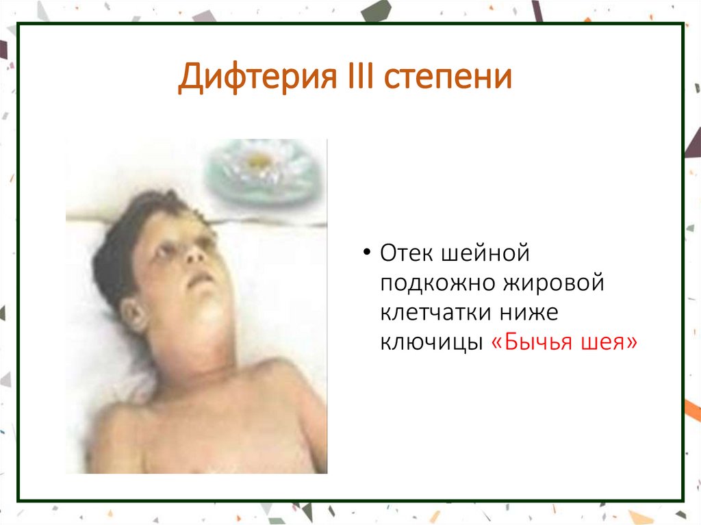 Дифтерия III степени