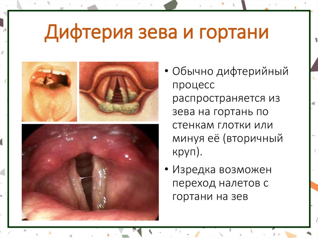 Дифтерия зева и гортани