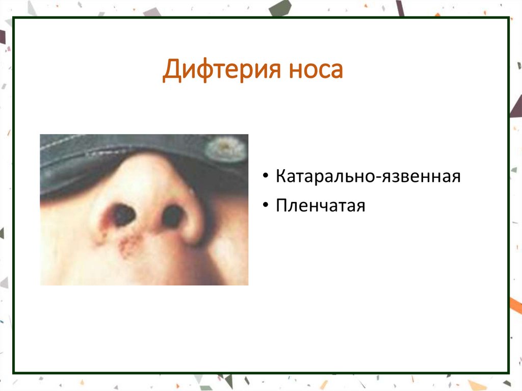 Дифтерия носа