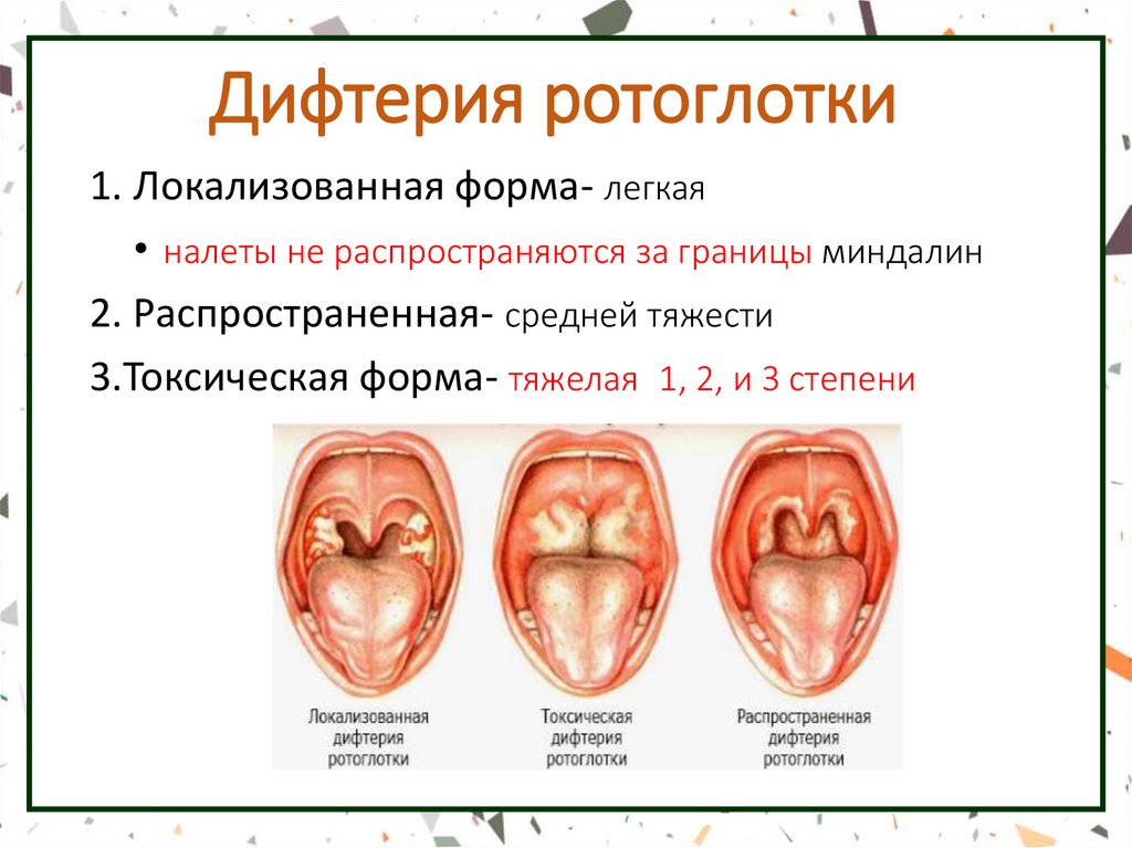 Дифтерия ротоглотки