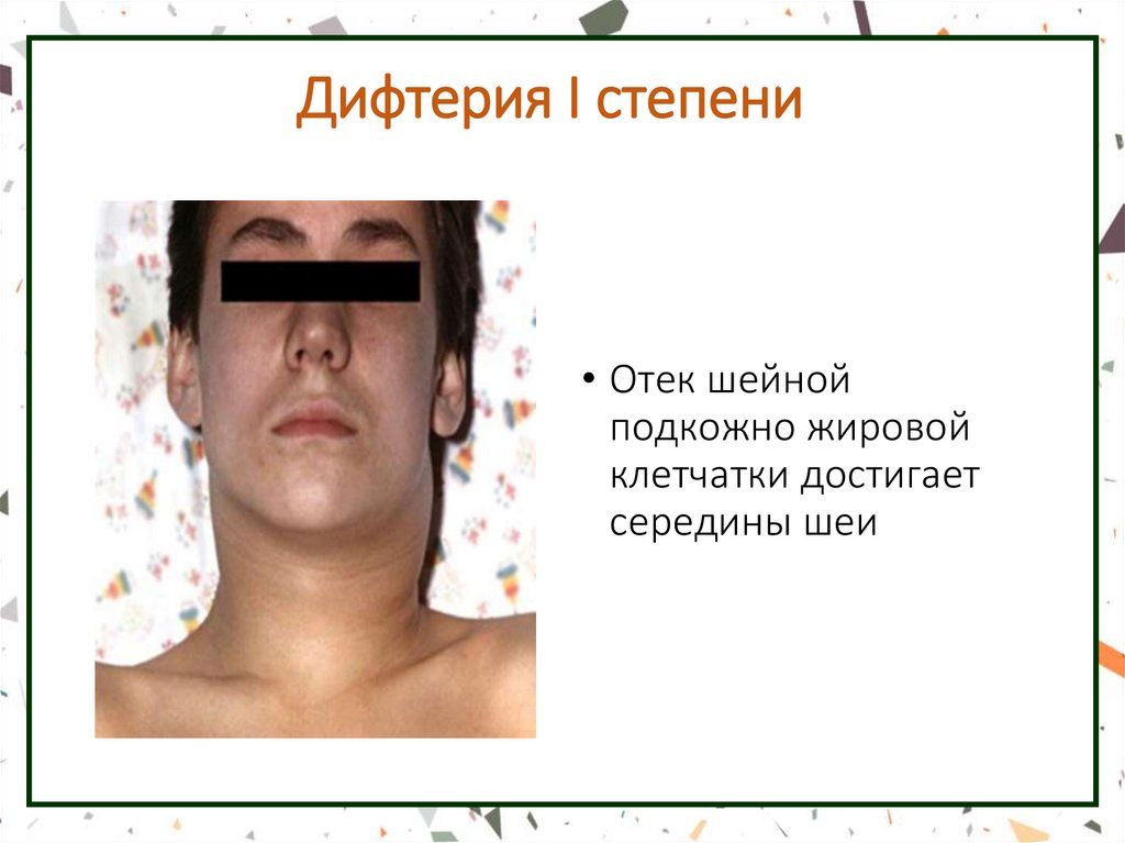 Дифтерия I степени