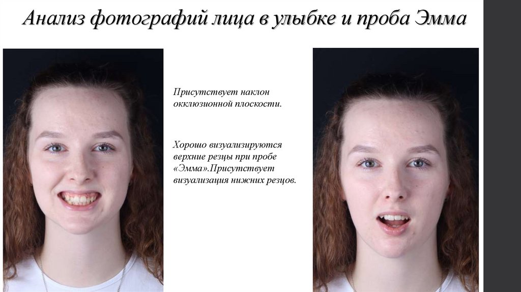 Анализ фотографий лица в улыбке и проба Эмма