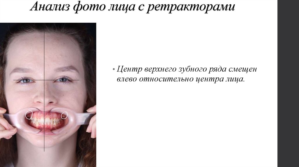 Анализ фото лица с ретракторами