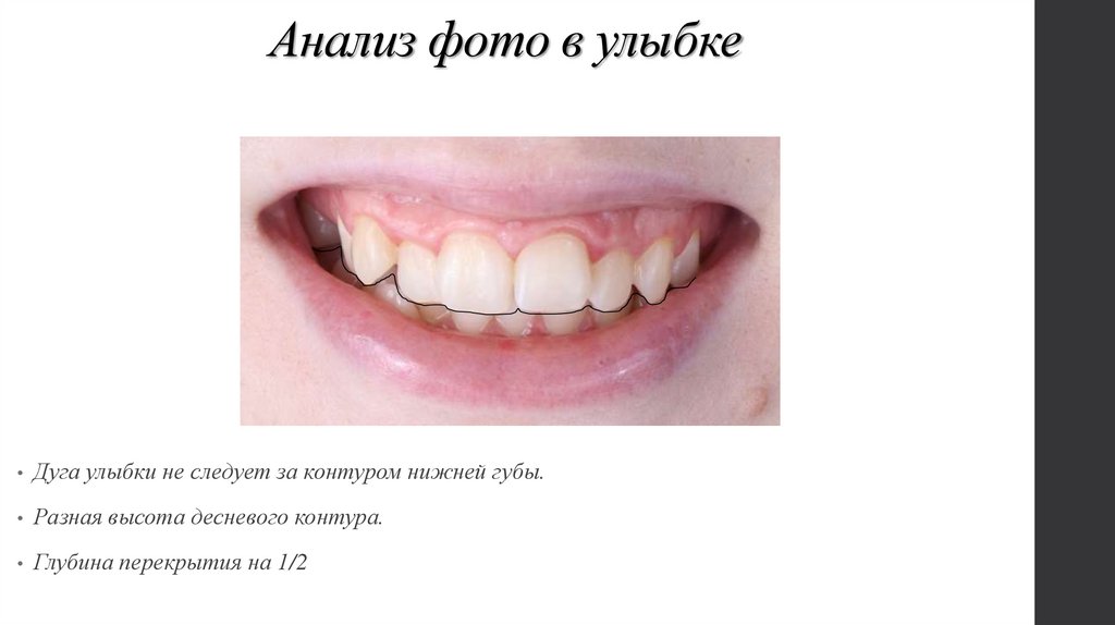 Анализ фото в улыбке