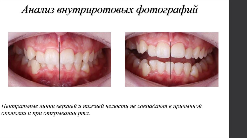 Анализ внутриротовых фотографий