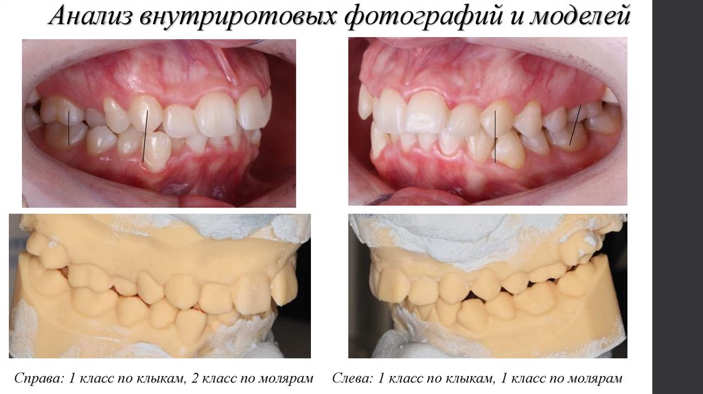 Анализ внутриротовых фотографий и моделей