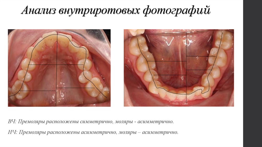 Анализ внутриротовых фотографий