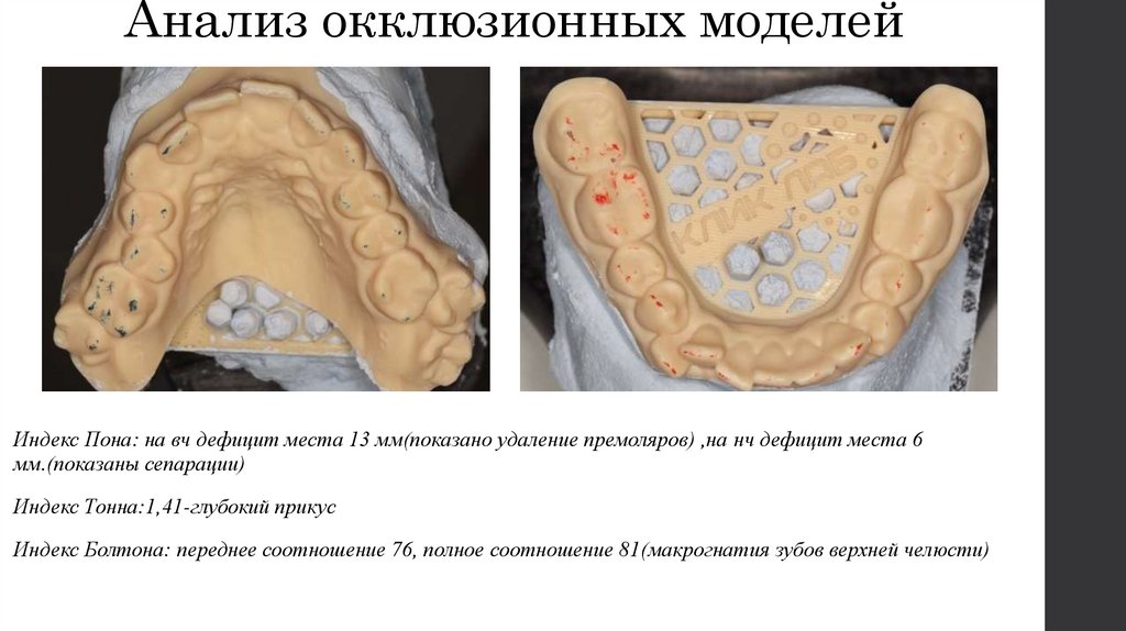 Анализ окклюзионных моделей