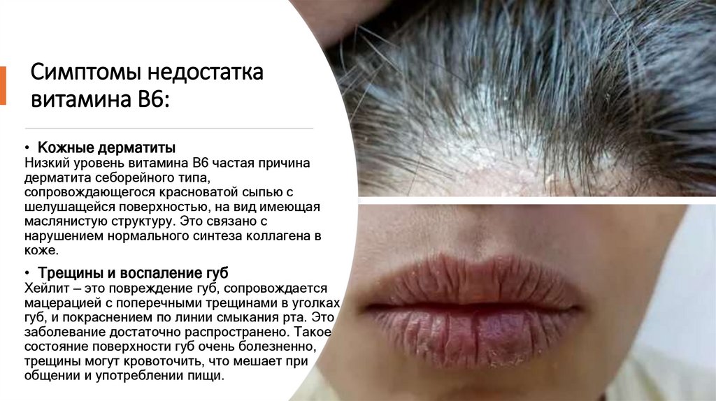 Симптомы недостатка витамина В6: