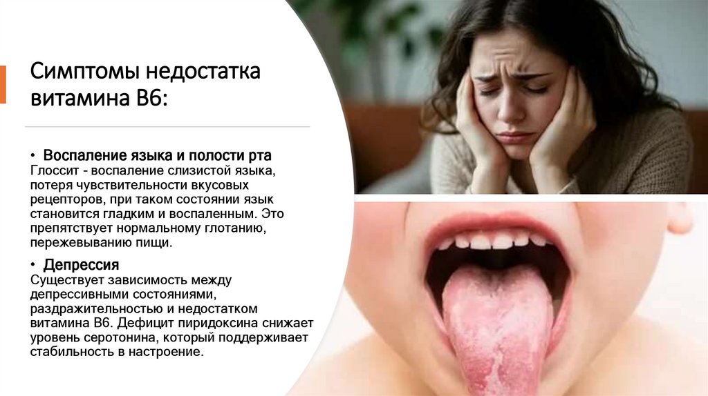 Симптомы недостатка витамина В6: