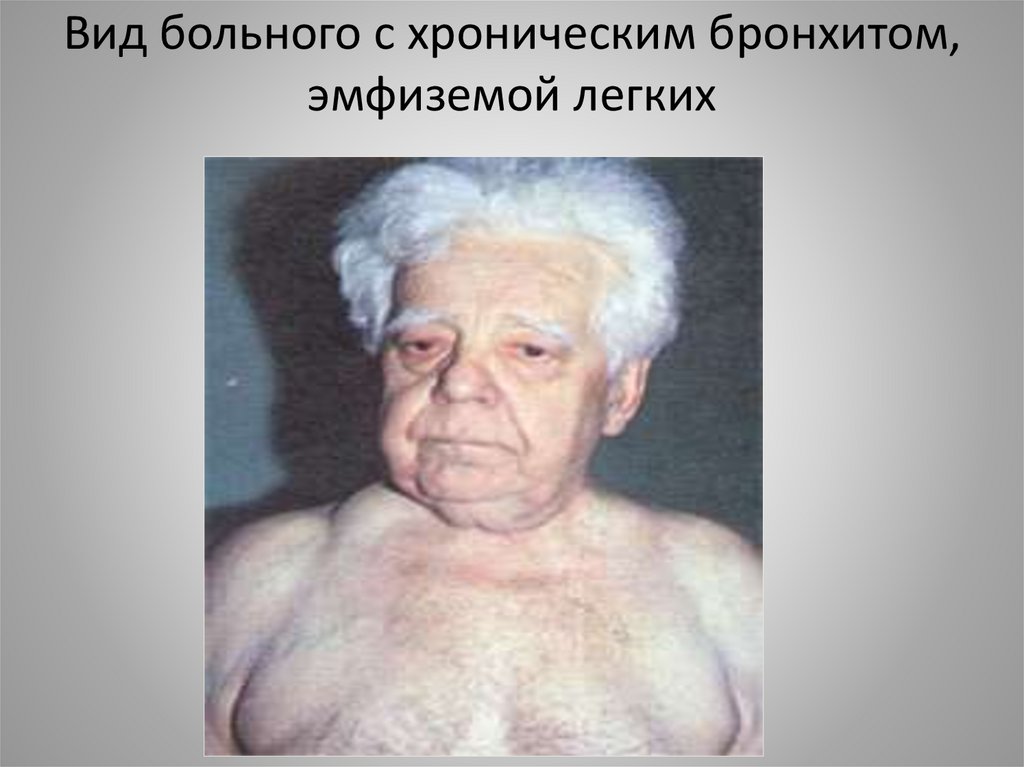 Вид больного с хроническим бронхитом, эмфиземой легких