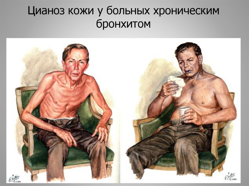 Цианоз кожи у больных хроническим бронхитом