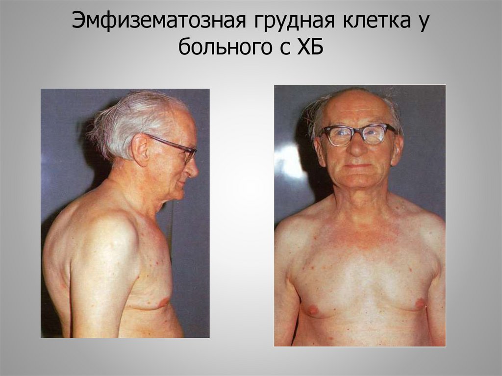 Эмфизематозная грудная клетка у больного с ХБ