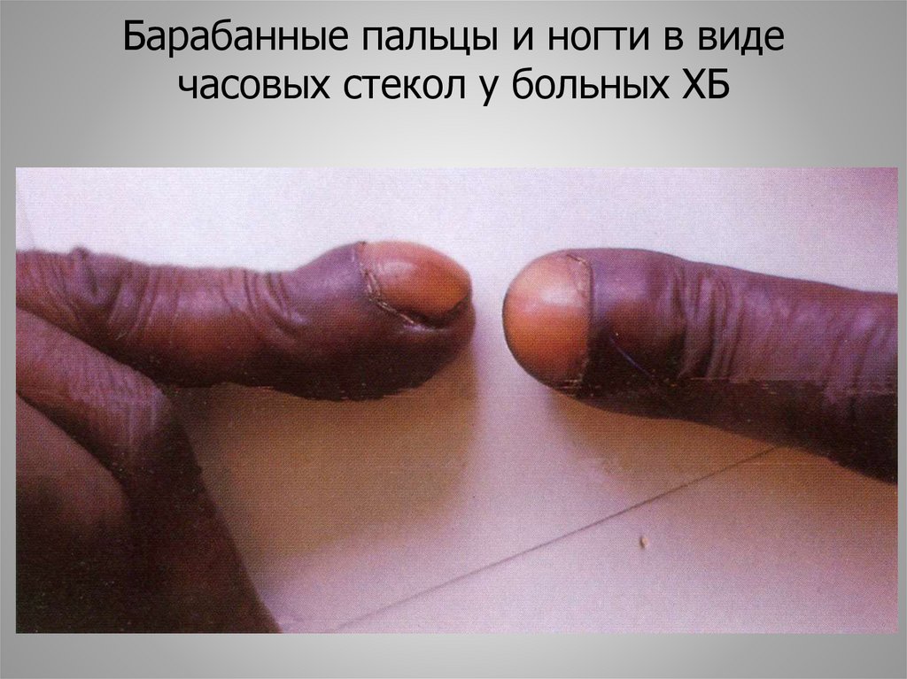 Барабанные пальцы и ногти в виде часовых стекол у больных ХБ