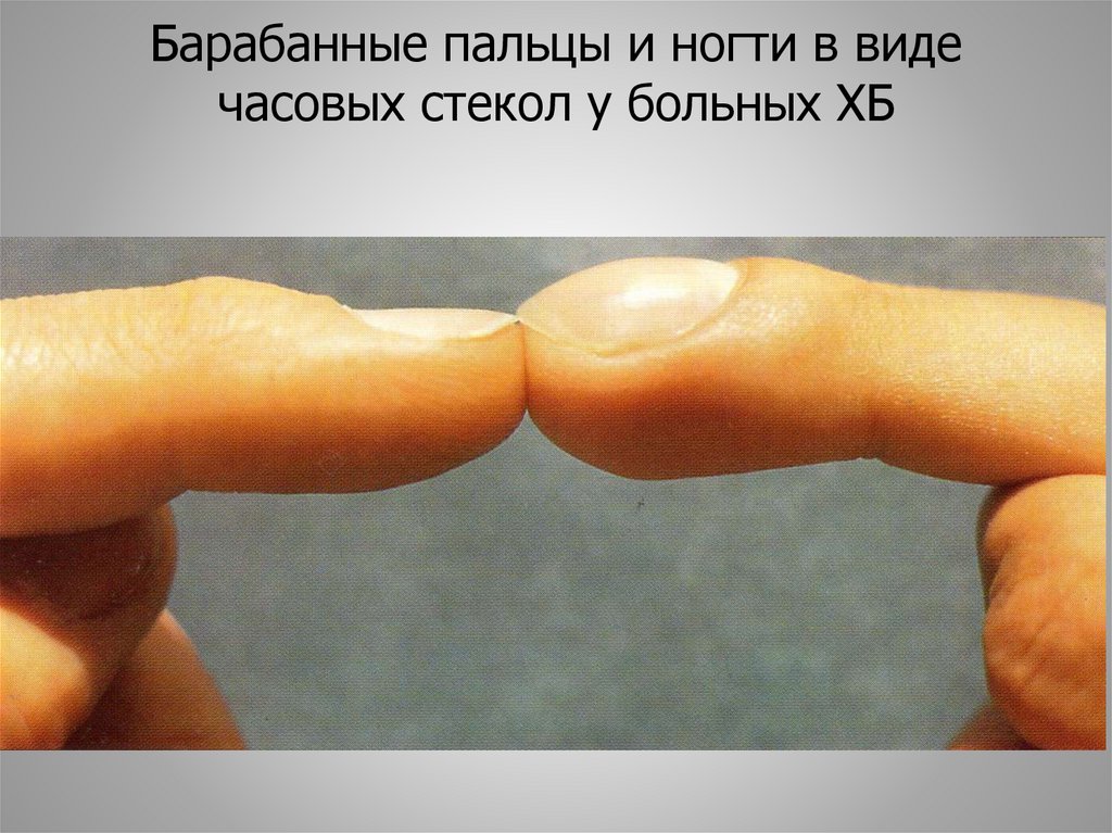 Барабанные пальцы и ногти в виде часовых стекол у больных ХБ