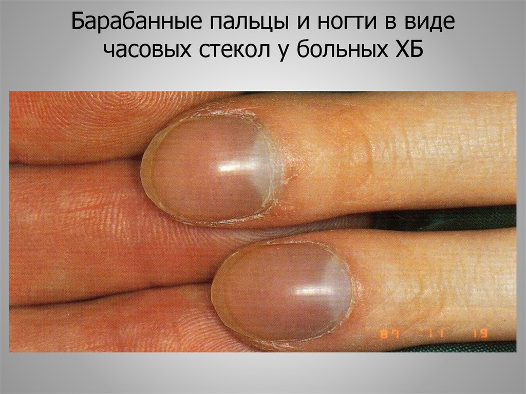 Барабанные пальцы и ногти в виде часовых стекол у больных ХБ
