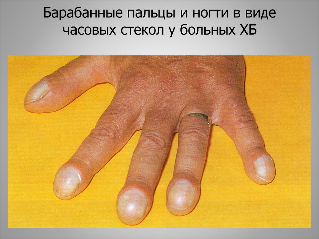 Барабанные пальцы и ногти в виде часовых стекол у больных ХБ