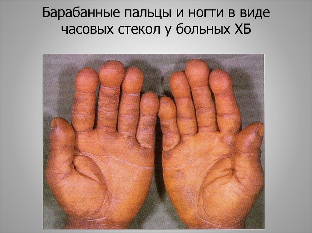 Барабанные пальцы и ногти в виде часовых стекол у больных ХБ