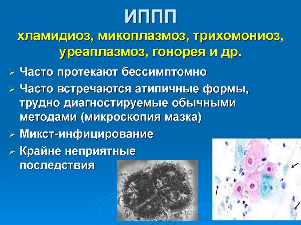 ИППП хламидиоз, микоплазмоз, трихомониоз, уреаплазмоз, гонорея и др.
